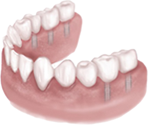 Guia para implante parcial Proguide 3D